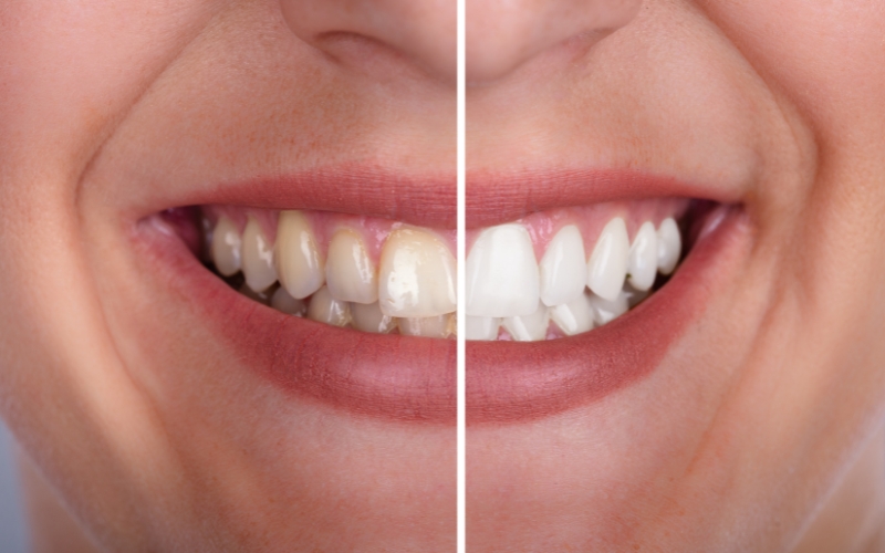 بلیچینگ دندان