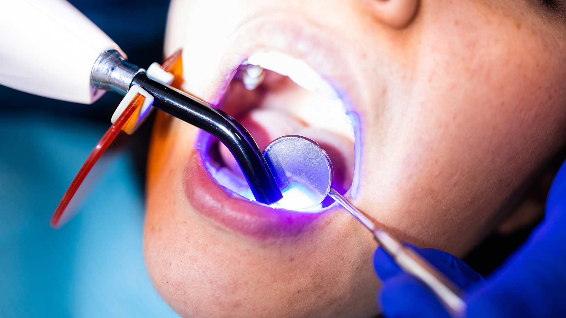 کامپوزیت ونیر